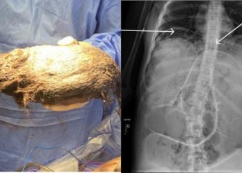 Çeşitli Şikayetlerle Hastaneye Dafvurdu: Ortaesinden Çakanlar Tabipleri Şöğir